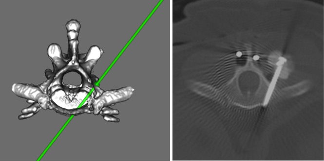implant recon